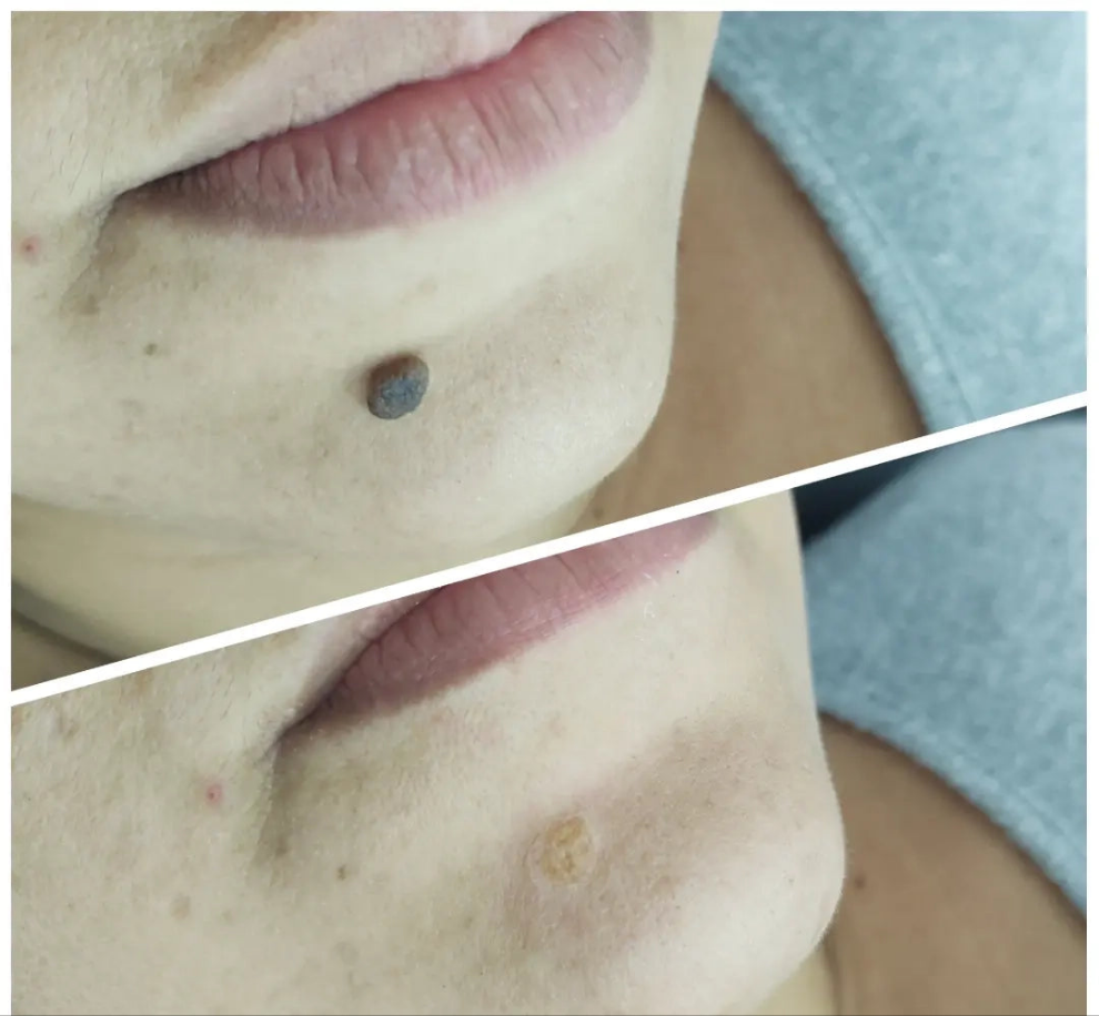 Elimina verrugas desde casa en segundos – ¡Sin dolor y sin cicatrices!"