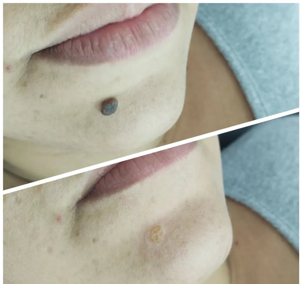 Elimina verrugas desde casa en segundos – ¡Sin dolor y sin cicatrices!"