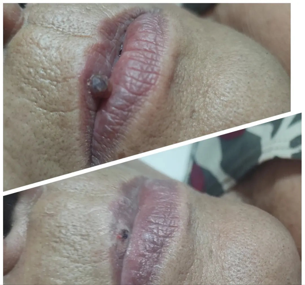 Elimina verrugas desde casa en segundos – ¡Sin dolor y sin cicatrices!"