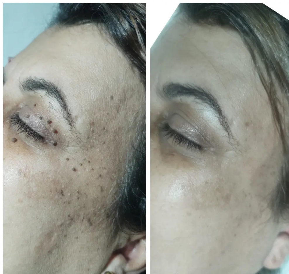 Elimina verrugas desde casa en segundos – ¡Sin dolor y sin cicatrices!"